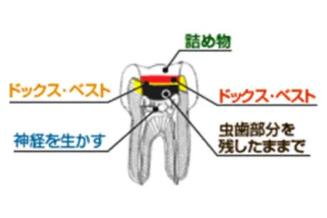 詰め物|ドックス・ベスト|ドックス・ベスト|神経を生かす|虫歯部分を残したままで