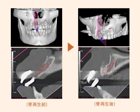 （骨再生前）→（骨再生後）